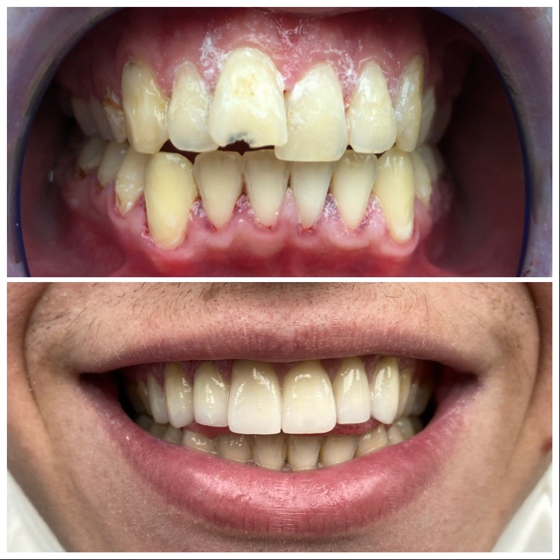 Cas clinique — Facettes dentaires