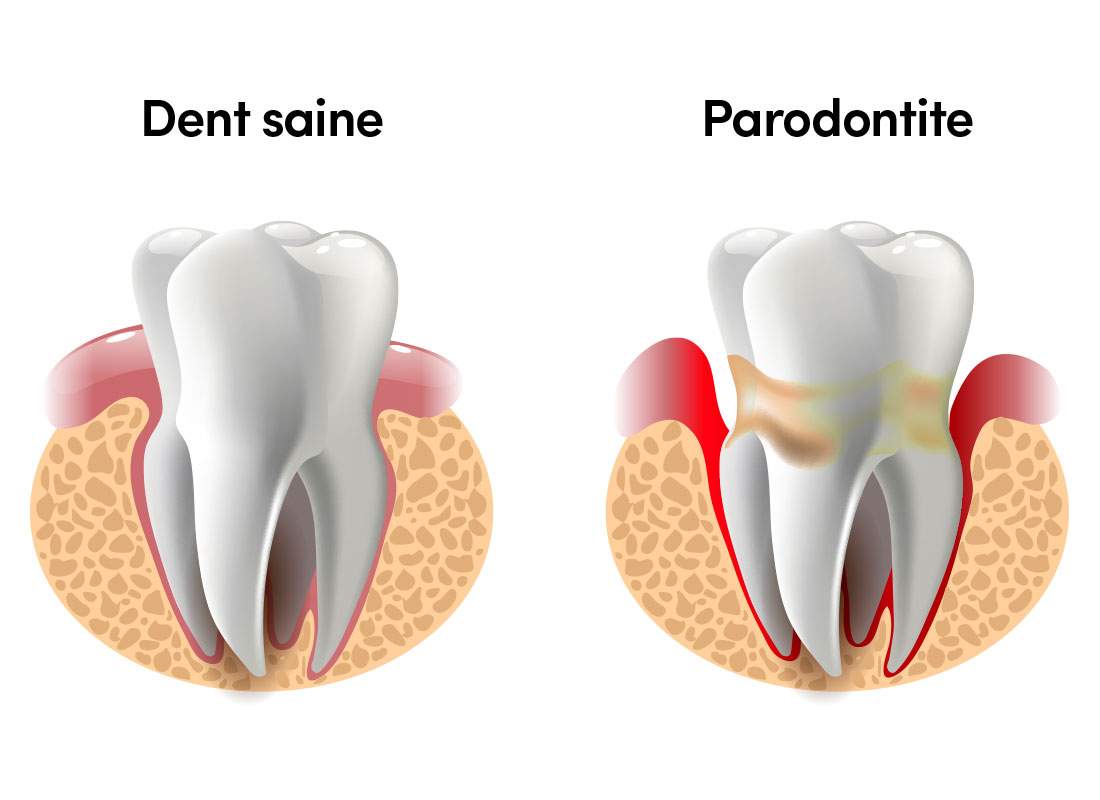 Illustration : dent saine vs dent atteinte de parodontite