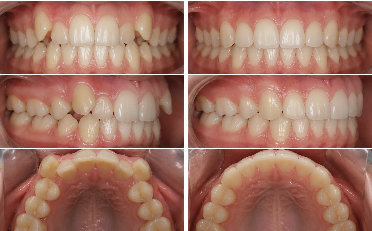 Résultat avant / après Invisalign — Invisalign — Cas n°6