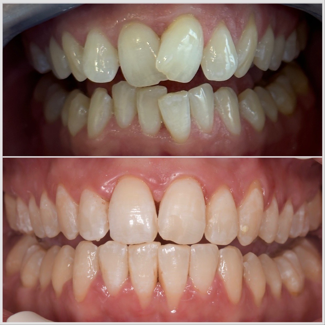 Résultat avant / après Invisalign — Invisalign — Cas n°4