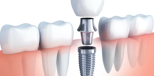 Schéma d'un implant dentaire (implant, pilier, couronne)