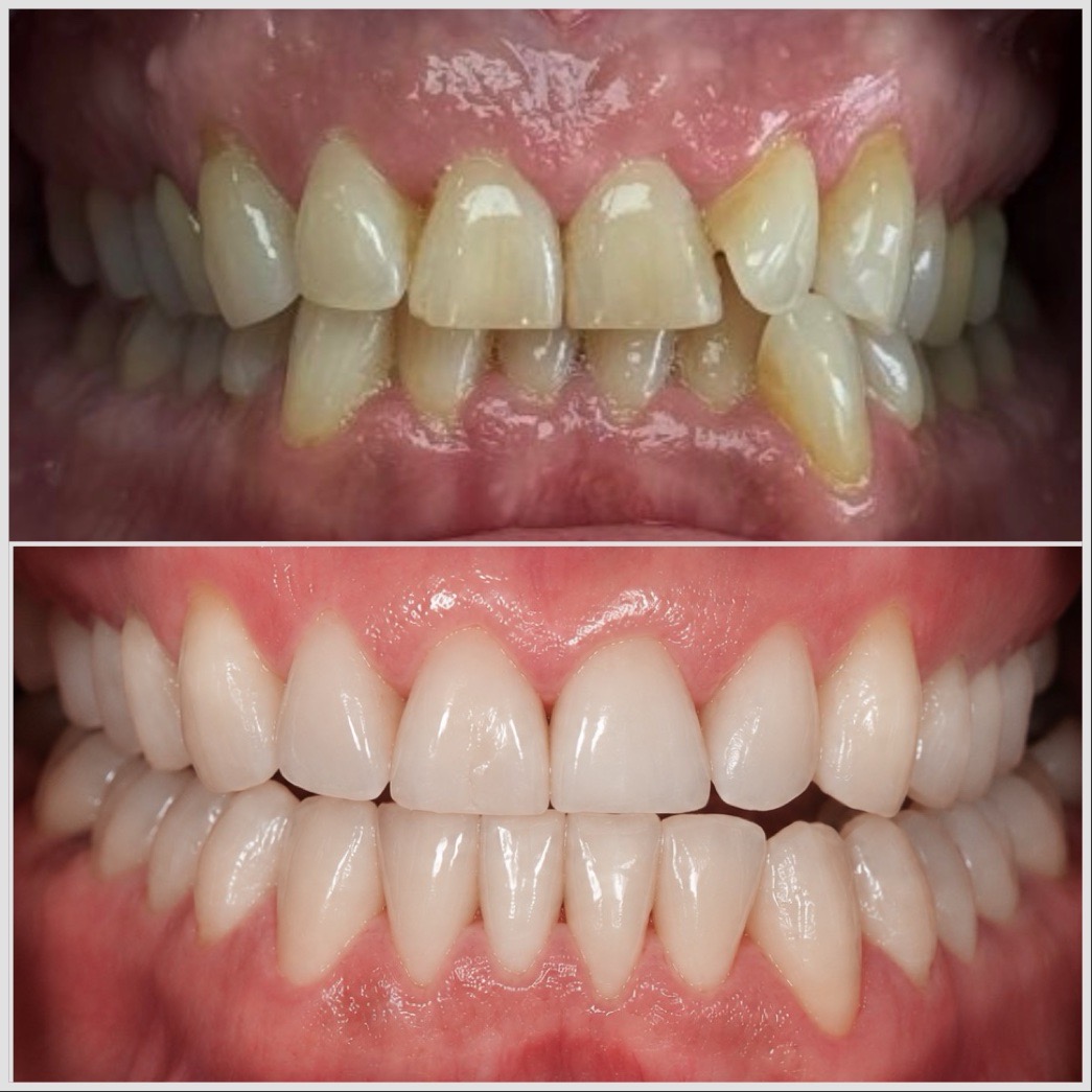 Cas clinique — Invisalign