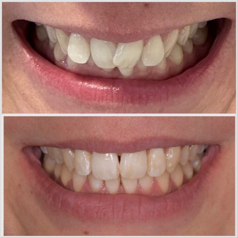 Invisalign — Cas n°3