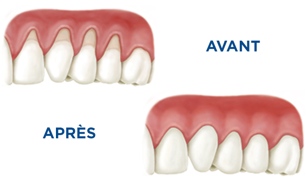 Illustration avant/après d'une greffe gingivale