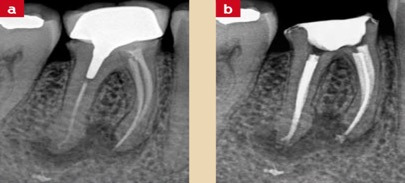 Radiographie illustrant un traitement endodontique avant/après
