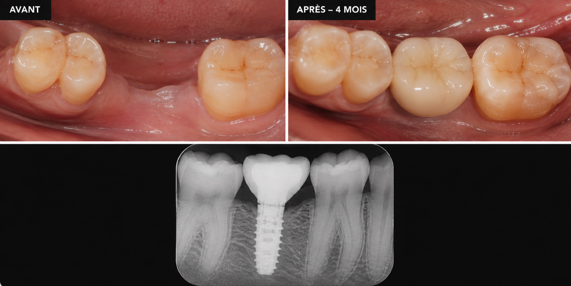 Résultat avant / après implant dentaire — Implant — Cas n°1