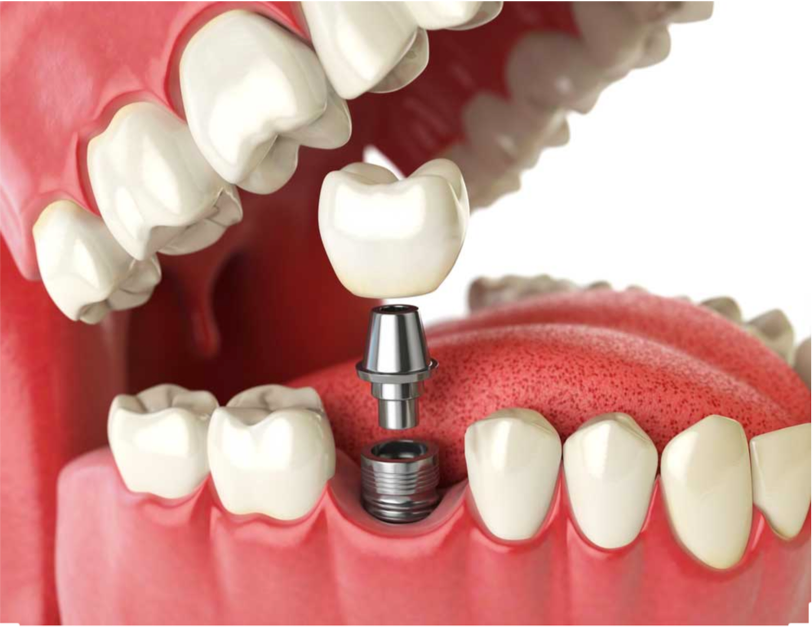 Illustration 3D d'un implant dentaire en bouche