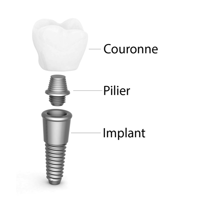 Schéma de la pose d'un implant sur arcade