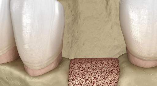 Illustration d'un comblement osseux avec biomatériau
