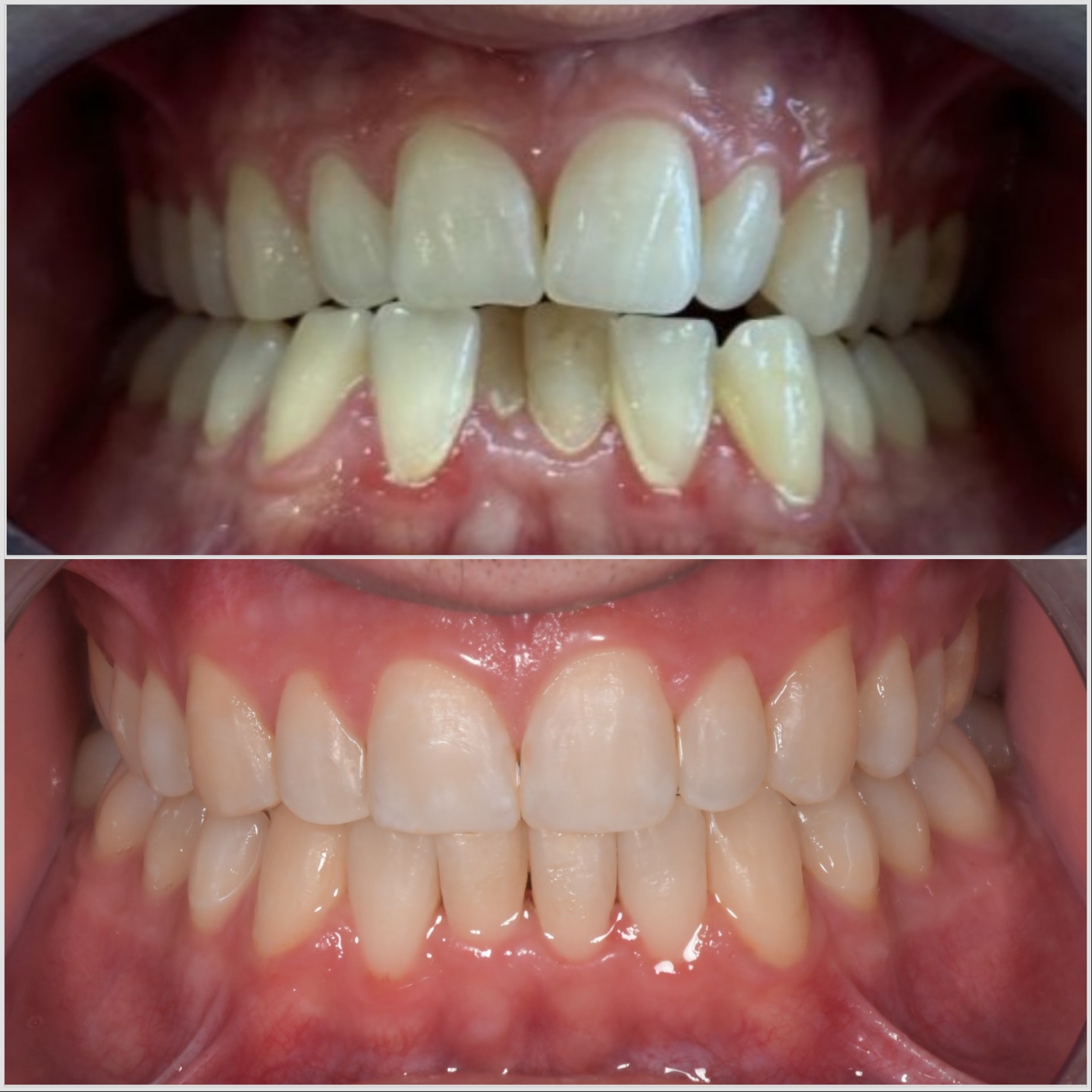 Invisalign — Cas n°2
